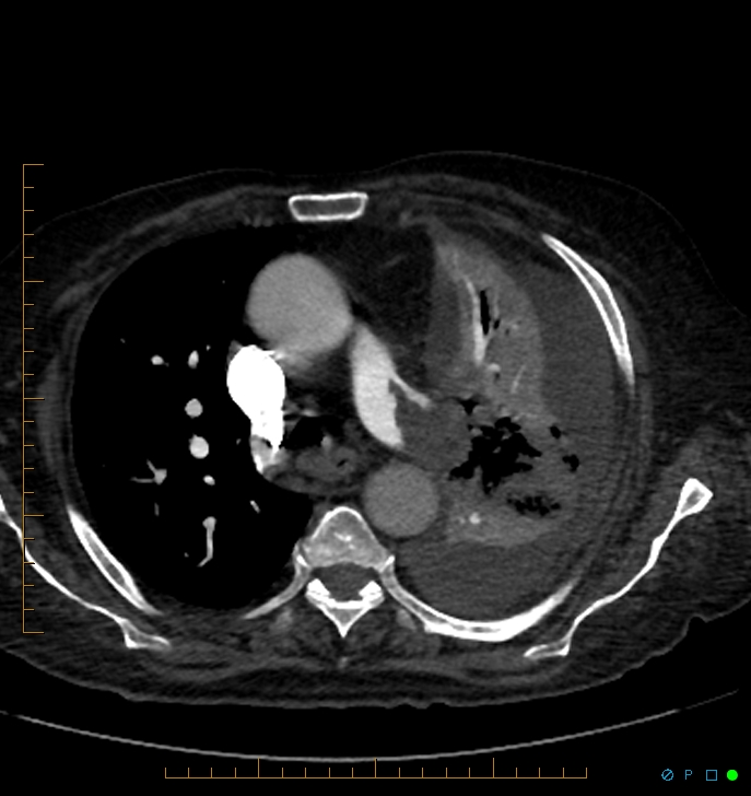 Cavitating pulmonary infarction (Radiopaedia 54634-60849 Axial C+ CTPA 25).jpg