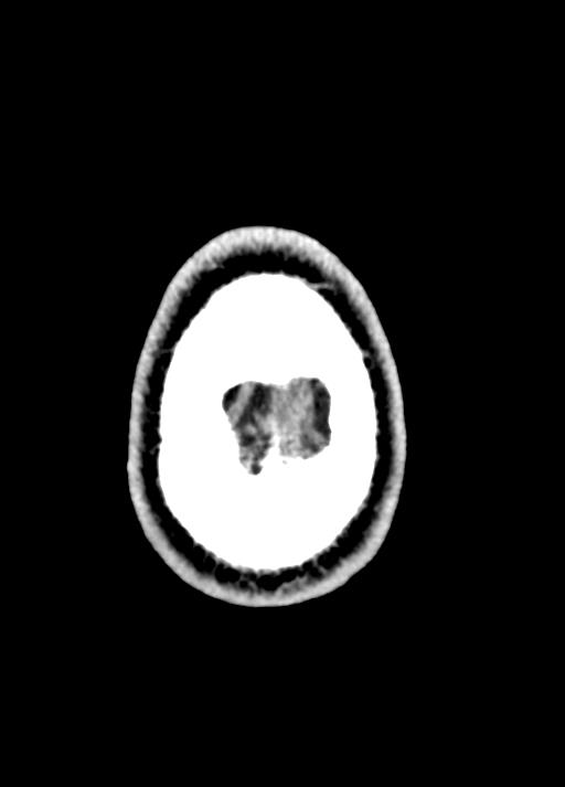 Cavum septum pellucidum and cavum vergae (Radiopaedia 77797-90060 Axial Brain Window 102).jpg