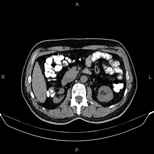 File:Cecal adenocarcinoma (Radiopaedia 85324-100916 Axial non-contrast 38).jpg