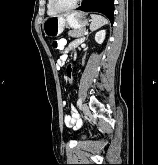 Cecal adenocarcinoma (Radiopaedia 85324-100916 E 59).jpg