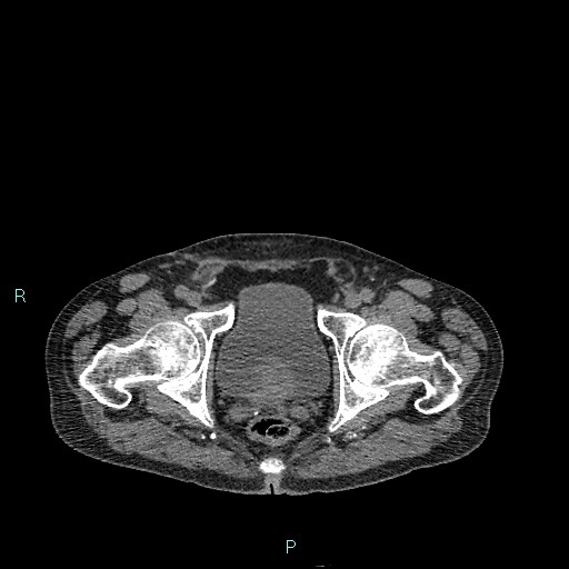 Cecal bascule (Radiopaedia 85770-101586 Axial non-contrast 102).jpg