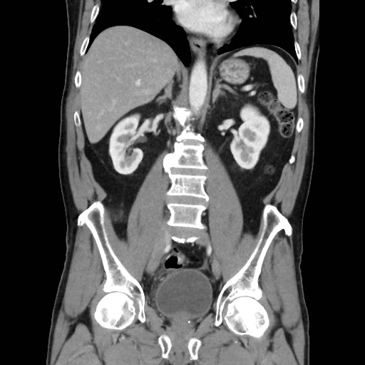 File:Cecal mass causing appendicitis (Radiopaedia 59207-66531 B 30).jpg