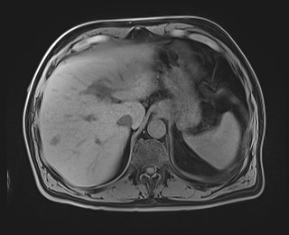 Cecal mass causing appendicitis (Radiopaedia 59207-66532 Axial T1 32).jpg