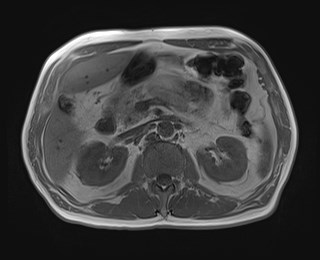 Cecal mass causing appendicitis (Radiopaedia 59207-66532 Axial T1 in-phase 52).jpg
