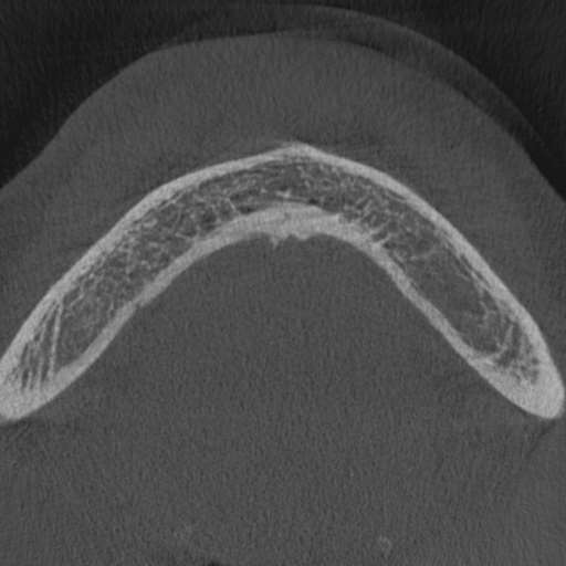 Cemento-osseous dysplasia (Radiopaedia 48251-53126 Axial non-contrast 1).jpg