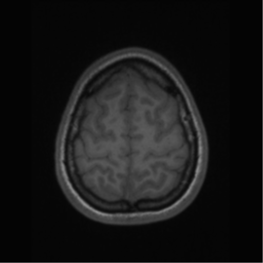 File:Central neurocytoma (Radiopaedia 37664-39557 Axial T1 63).png