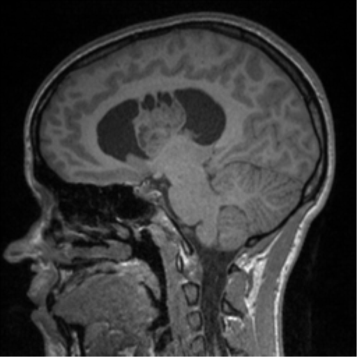 Central neurocytoma (Radiopaedia 37664-39557 Sagittal T1 44).png