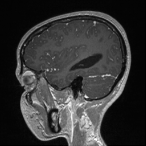 Central neurocytoma (Radiopaedia 37664-39557 Sagittal T1 C+ 26).png