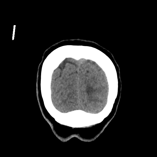 Central neurocytoma (Radiopaedia 65317-74346 Coronal non-contrast 56).png