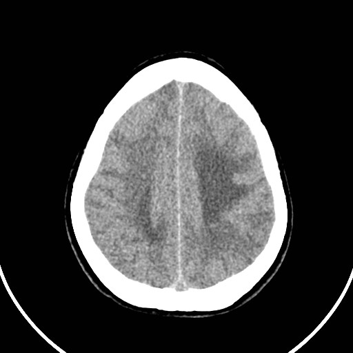 File:Central neurocytoma (Radiopaedia 84497-99871 Axial non-contrast 41).jpg