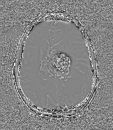 File:Central neurocytoma (Radiopaedia 84497-99872 Axial 44).jpg
