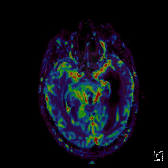 Central neurocytoma (Radiopaedia 84497-99872 Axial Perfusion 193).jpg