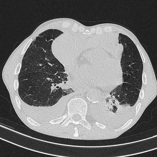 Central venous catheter tip extravasation (Radiopaedia 82828-97113 Axial lung window 56).jpg