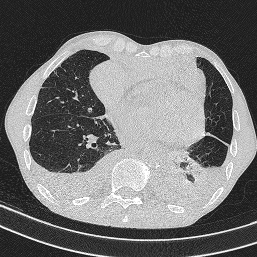 Central venous catheter tip extravasation (Radiopaedia 82828-97113 Axial lung window 58).jpg