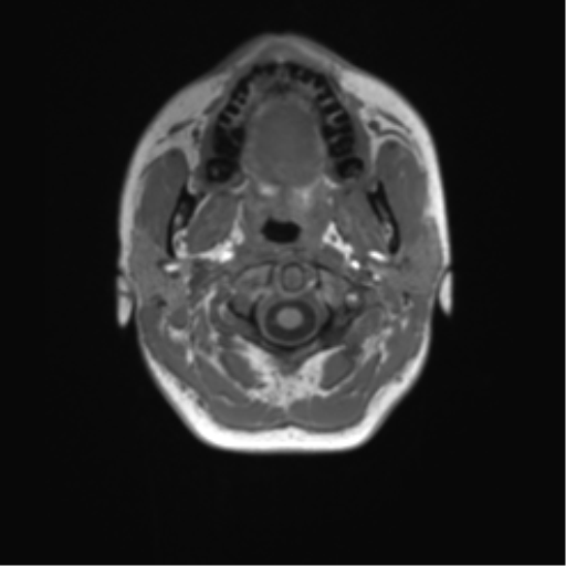 Cerebellar agenesis with hypoplastic pons (pontocerebellar hypoplasia) (Radiopaedia 57224-64138 Axial T1 3).png
