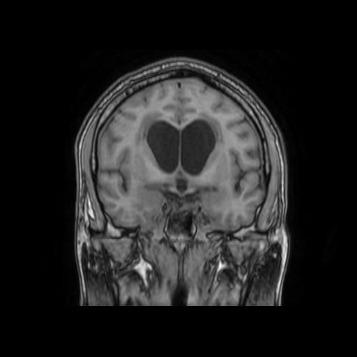 File:Cerebellar hemangioblastoma (Radiopaedia 88055-104622 Coronal T1 16).jpg