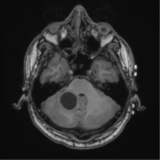 Cerebellar hemangioblastomas and pituitary adenoma (Radiopaedia 85490-101176 Axial T1 19).png