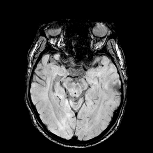 Cerebellar hemorrhage (Radiopaedia 37000-38666 Axial Gradient Echo 35).png