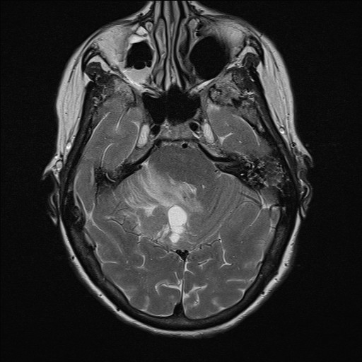 File:Cerebellar metastases (Radiopaedia 24038-24249 Axial T2 8).jpg