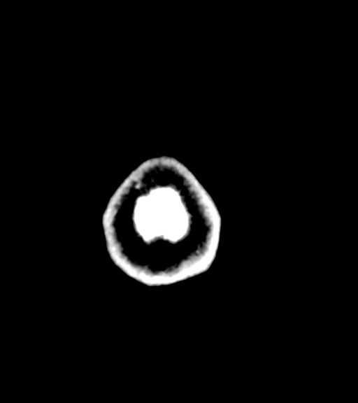 Cerebellar metastases - colorectal adenocarcinoma (Radiopaedia 40947-43652 Axial C+ 66).png