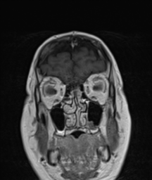 File:Cerebellar metastasis (Radiopaedia 54578-60810 Coronal T1 C+ 5).png