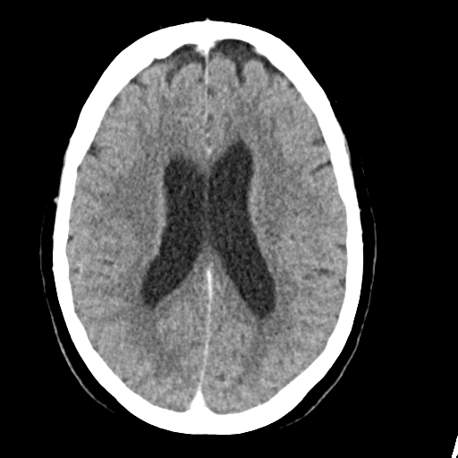 Cerebellar metastasis (Radiopaedia 54578-60812 Axial C+ 30).png