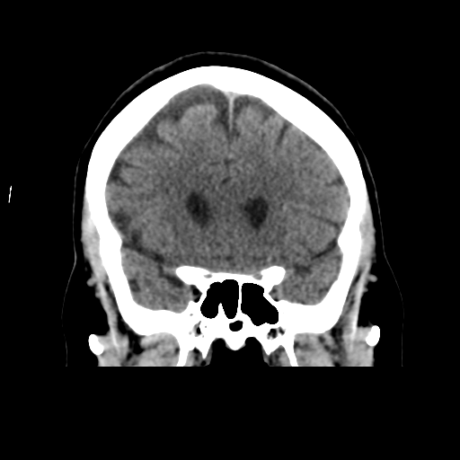Cerebellar metastasis (cystic appearance) (Radiopaedia 41395-44258 Coronal non-contrast 23).png