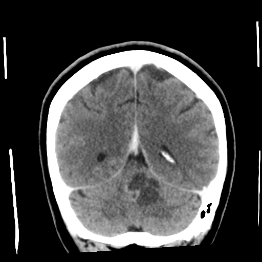 Cerebellar metastasis (cystic appearance) (Radiopaedia 41395-44258 D 45).png