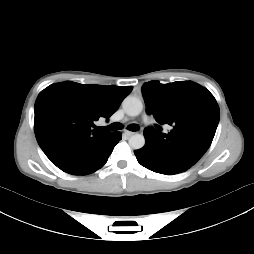 Cerebellar metastasis - adenocarcinoma lung (Radiopaedia 63184-71717 Axial C+ delayed 28).png