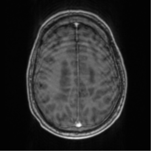 Cerebellar metastasis from lung adenocarcinoma (Radiopaedia 86690-102829 Axial T1 C+ 59).png