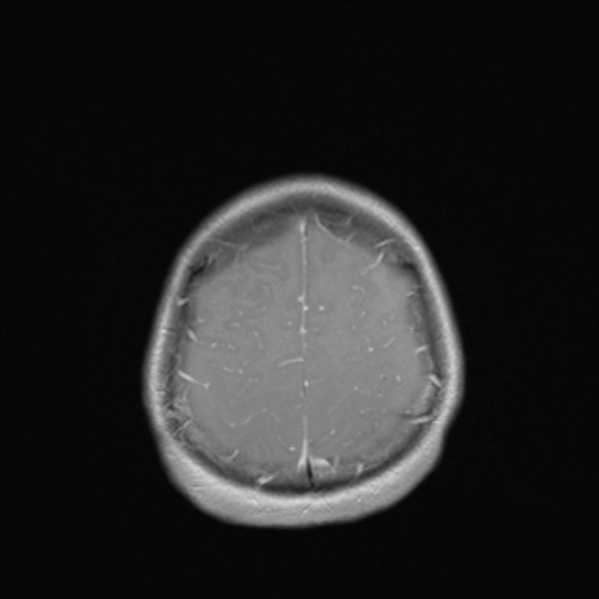 File:Cerebral abscess (Radiopaedia 24212-24478 Axial T1 C+ 50).jpg