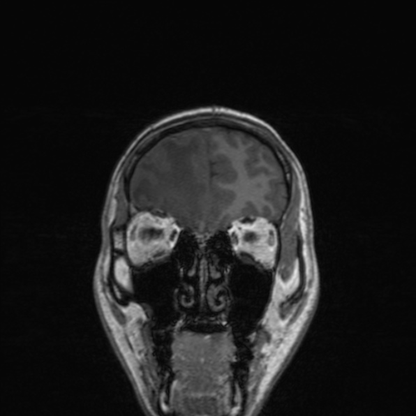 Cerebral abscess (Radiopaedia 24212-24478 Coronal T1 52).jpg