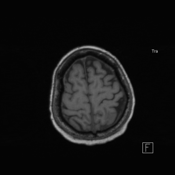 Cerebral abscess (Radiopaedia 26111-26247 Axial T1 47).jpg