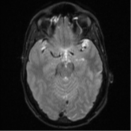 Cerebral abscess (Radiopaedia 60342-68009 Axial DWI 13).png