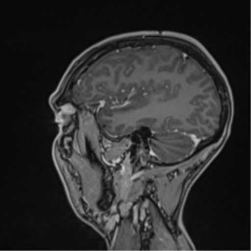 Cerebral abscess (Radiopaedia 60342-68009 J 16).png