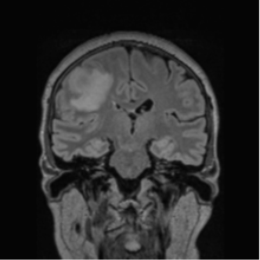Cerebral abscess from pulmonary arteriovenous malformation (Radiopaedia 86275-102291 Coronal FLAIR 42).png