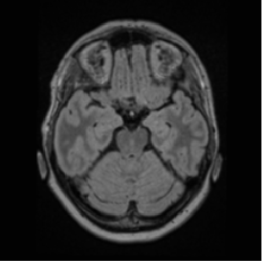 File:Cerebral abscess from pulmonary arteriovenous malformation (Radiopaedia 86275-102291 J 29).png