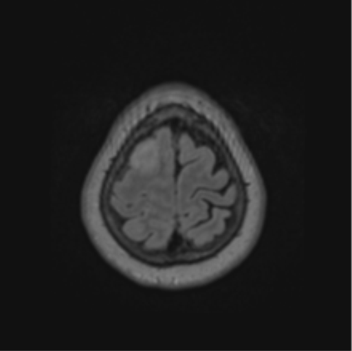 Cerebral abscess from pulmonary arteriovenous malformation (Radiopaedia 86275-102291 J 67).png