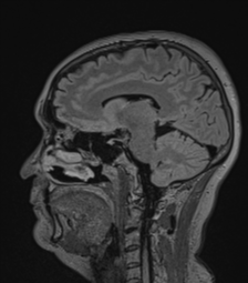 Cerebral abscess from pulmonary arteriovenous malformation (Radiopaedia 86275-102291 Sagittal FLAIR 33).png