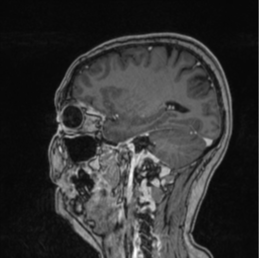 Cerebral abscess from pulmonary arteriovenous malformation (Radiopaedia 86275-102291 Sagittal T1 C+ 26).png