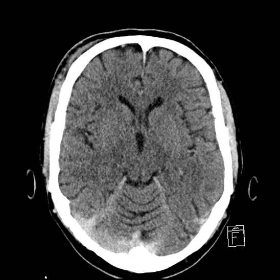 File:Cerebral abscess with ventriculitis (Radiopaedia 78965-91877 A 21).jpg