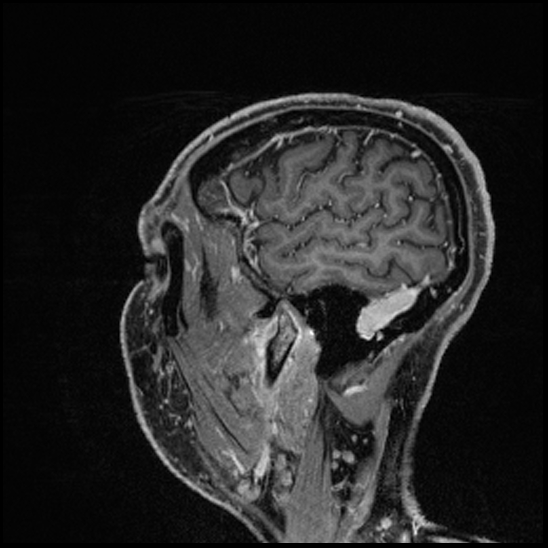 Cerebral abscess with ventriculitis (Radiopaedia 78965-91878 Sagittal T1 C+ 151).jpg