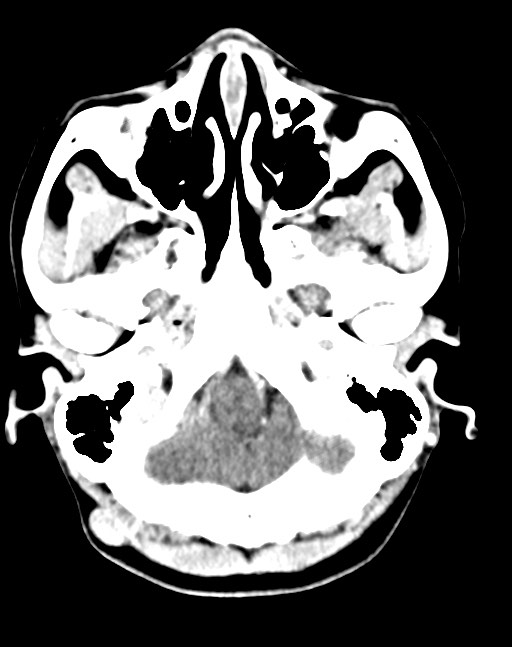 Cerebral abscesses (Radiopaedia 70458-80568 Axial Contrast 14).jpg