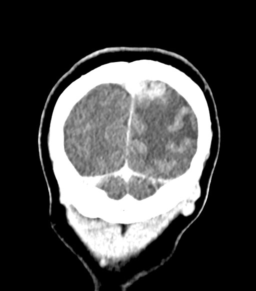 File:Cerebral abscesses (Radiopaedia 70458-80568 Coronal Contrast 59).jpg