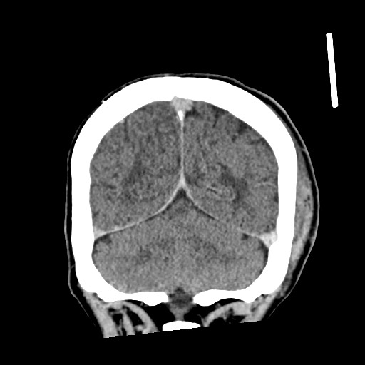 Cerebral amyloid angiopathy-related inflammation (Radiopaedia 74836-85848 Coronal non-contrast 56).jpg