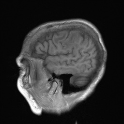 File:Cerebral amyloid angiopathy-related inflammation (Radiopaedia 74836-85849 Sagittal T1 8).jpg