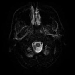 Cerebral amyloid angiopathy (Radiopaedia 28698-28978 Axial DWI 30).jpg