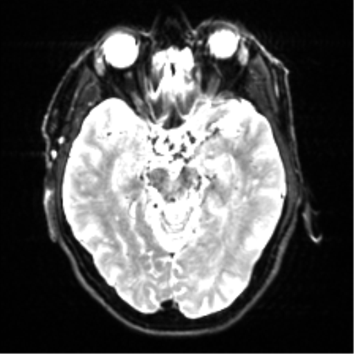 Cerebral amyloid angiopathy (Radiopaedia 46082-50433 Axial DWI 10).png