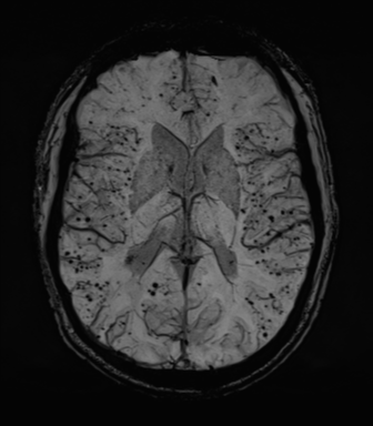 File:Cerebral amyloid angiopathy (Radiopaedia 46082-50433 Axial SWI MIP 42).png