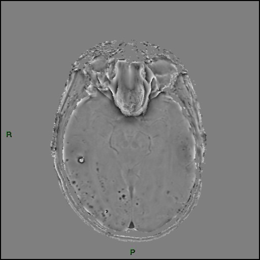 Cerebral amyloid angiopathy (Radiopaedia 77506-89664 H 45).jpg